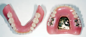 イボカップシステム義歯