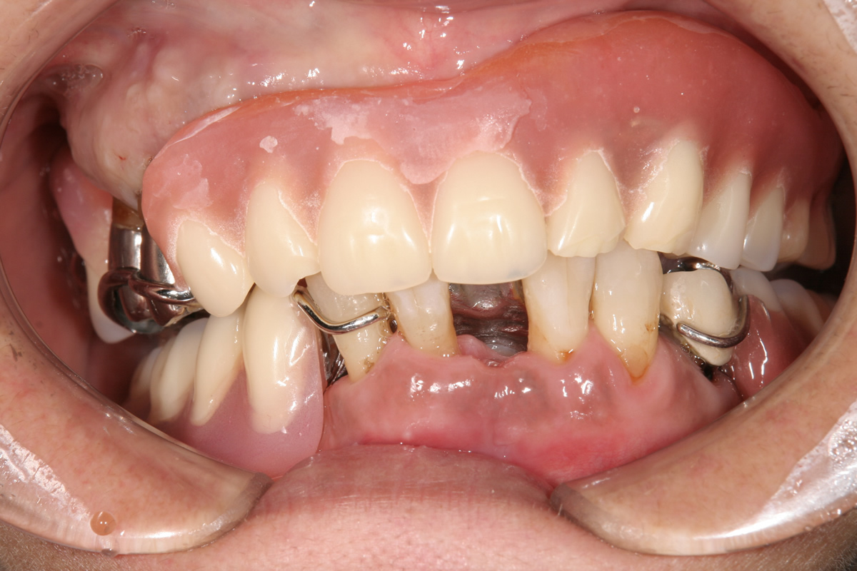 イボカップシステム義歯 術前写真
