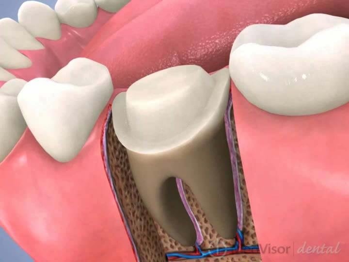 歯内療法（根管治療）
